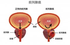 用上光邦光子治疗仪，对症治疗前列腺问题
